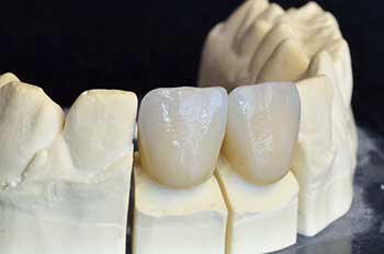 Astoria Dental Crowns