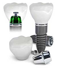 Astoria Dental Implants