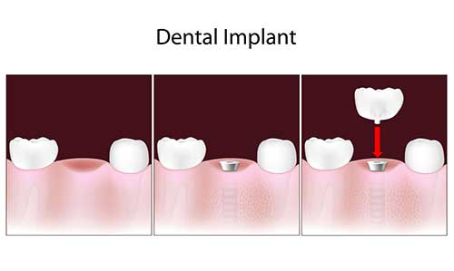 Implant Dentist in Astoria