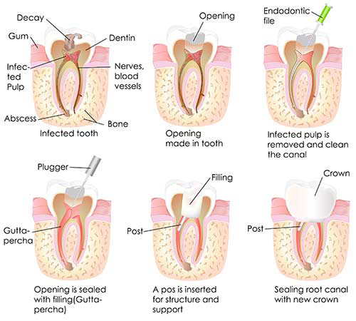 Astoria Root Canal