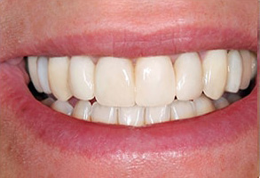 Astoria Before and After Teeth Whitening