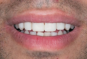 Before and After Dental Implants