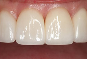 Astoria Before and After Teeth Whitening