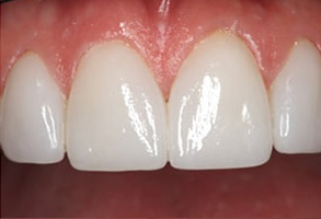 Before and After Dental Implants