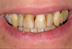  Before and After Dental Implants