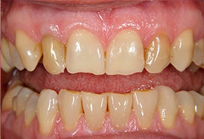 Queens Before and After Veneers