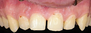 Astoria Before and After Teeth Whitening
