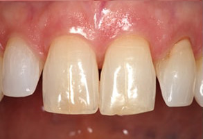 Before and After Dental Implants