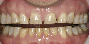 Queens Before and After Veneers